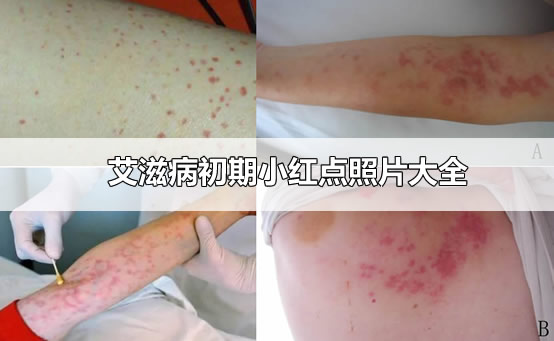 你身上的“小红点”是不是艾滋急性期皮疹？ - 知乎