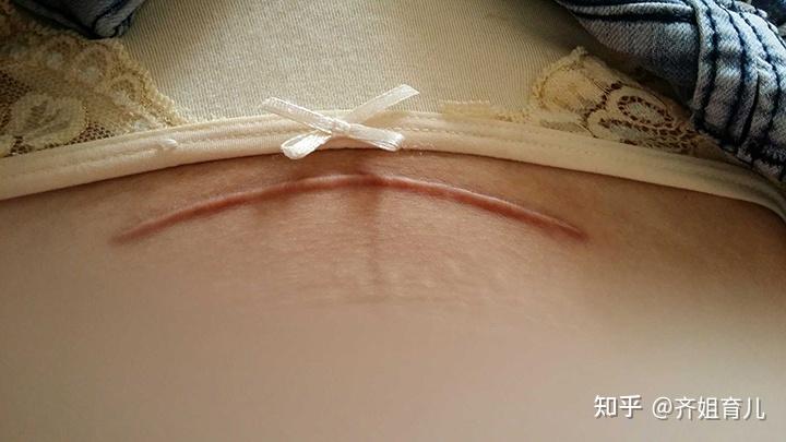 顺产还是剖腹产开十指或腹剖七层都要更注重产后护理