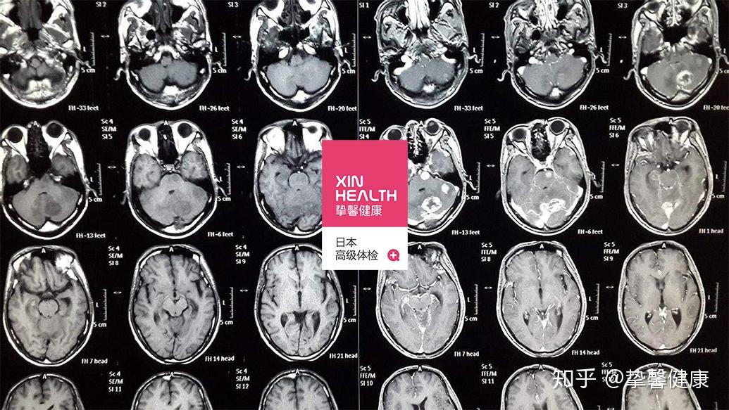 X光、b超、ct、核磁共振 Mri 的区别 知乎