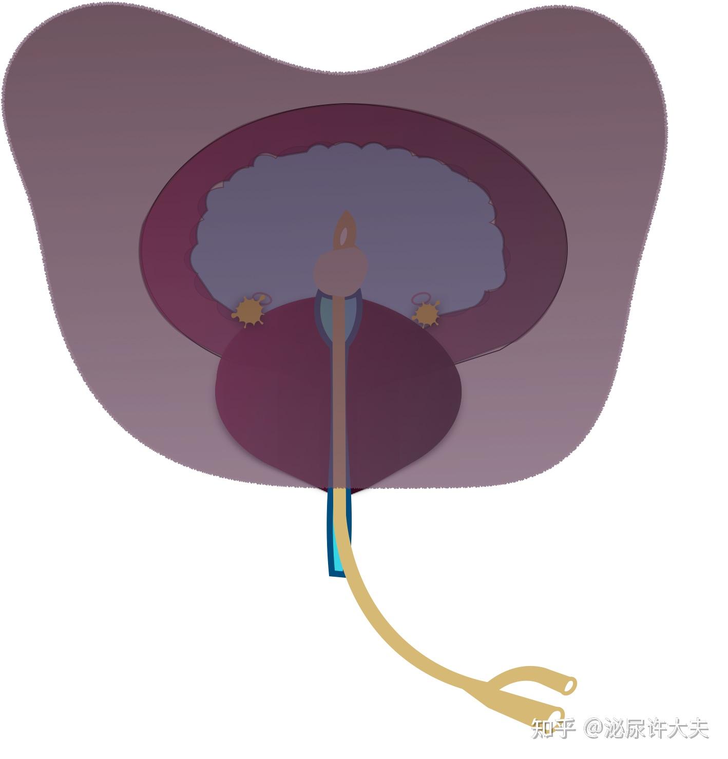 膀胱造瘘位置图图片