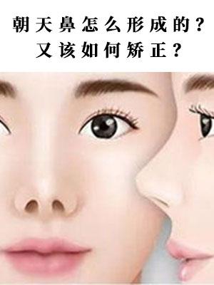 朝天鼻怎么形成的?又该如何矫正? - 知乎