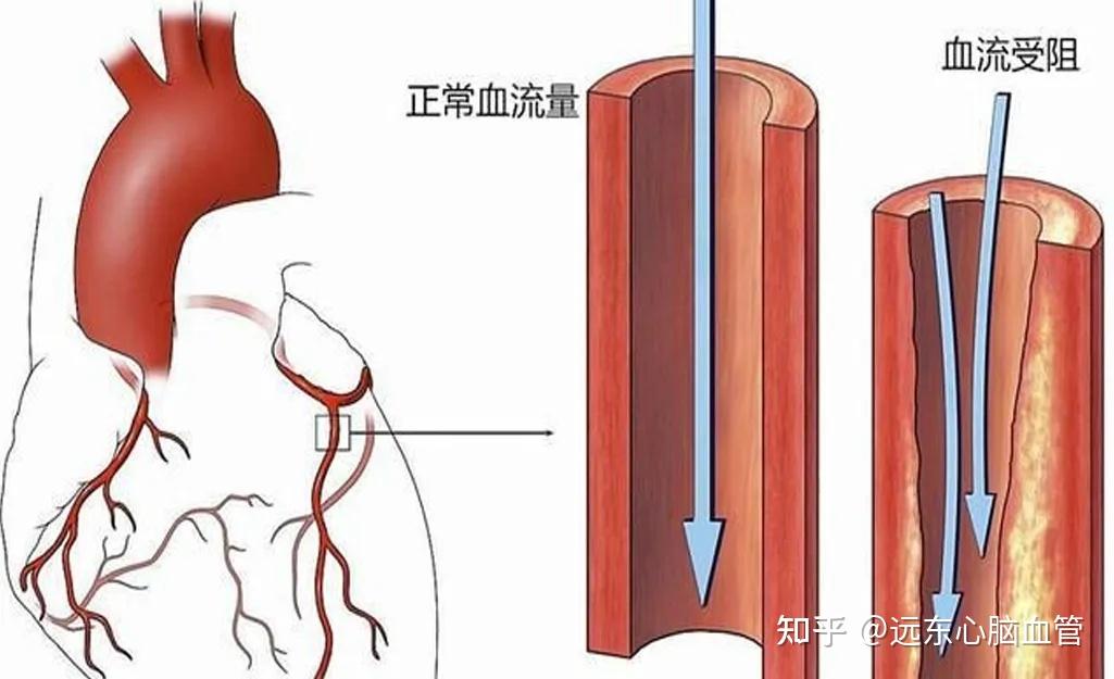 導致心肌缺血缺氧而壞死,是冠心病發生髮展的一個嚴重狀態;5,病因:心