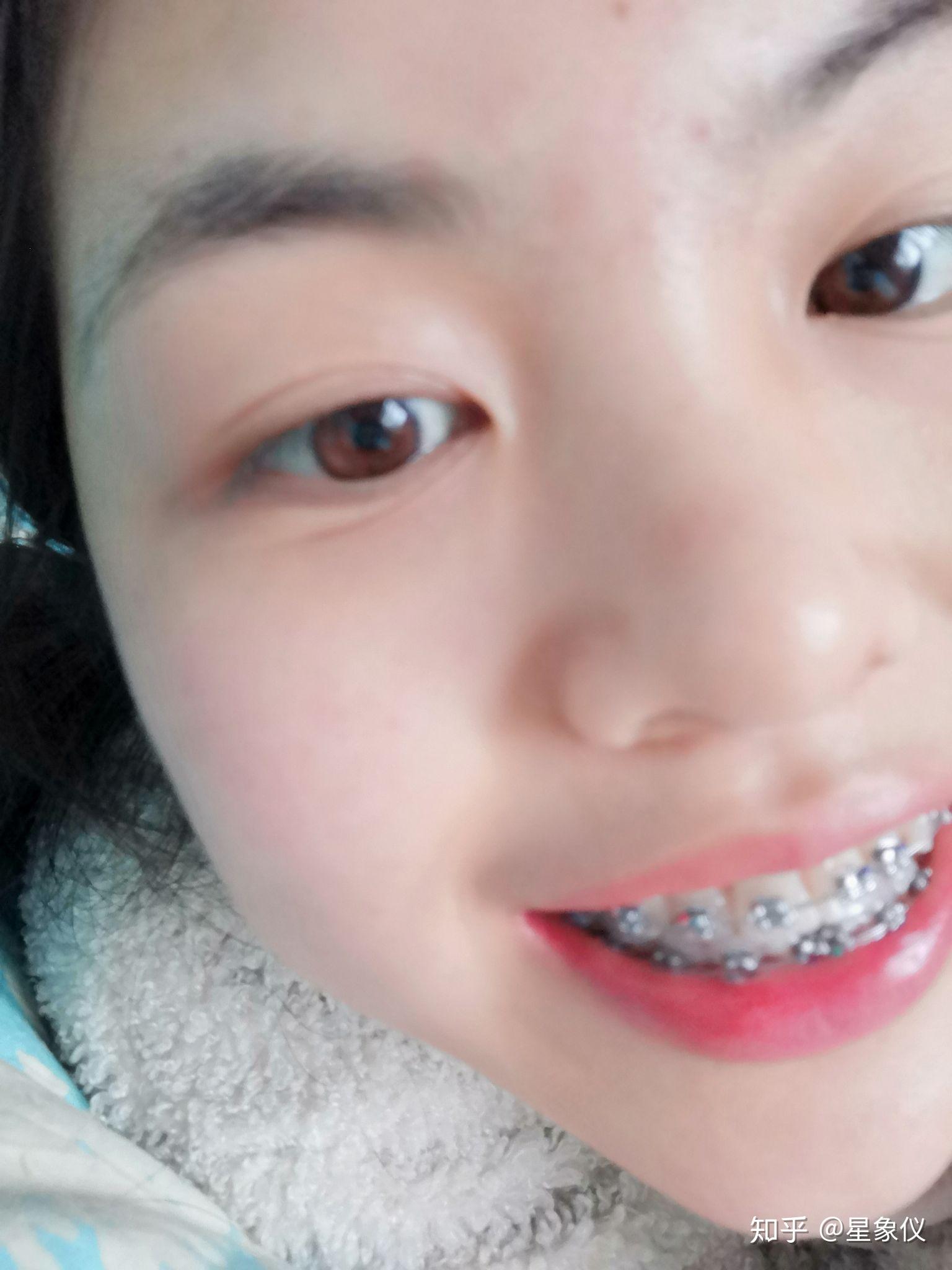 正畸日记可爱小钢牙
