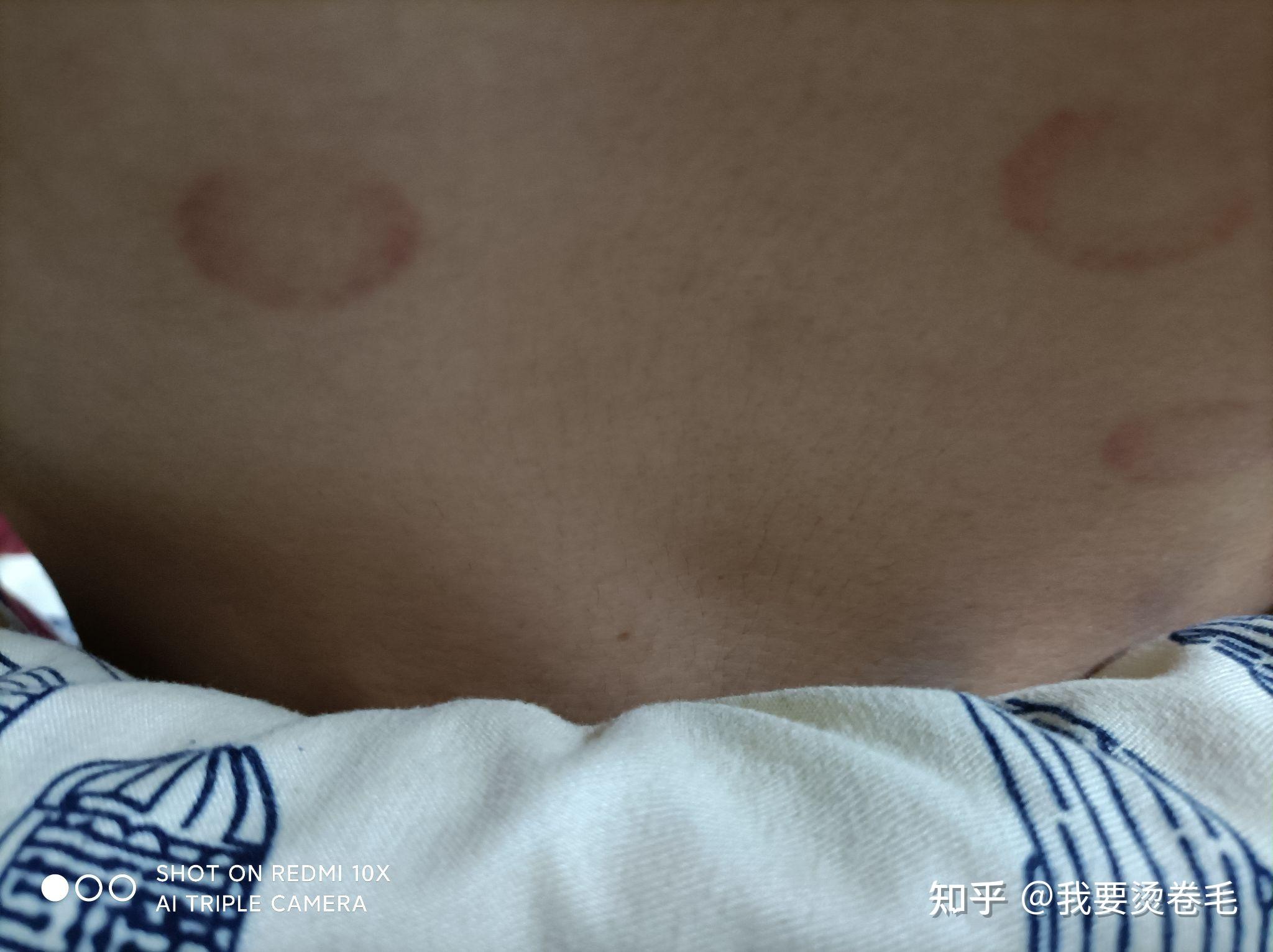 现在心电图吸盘有什么缺陷?