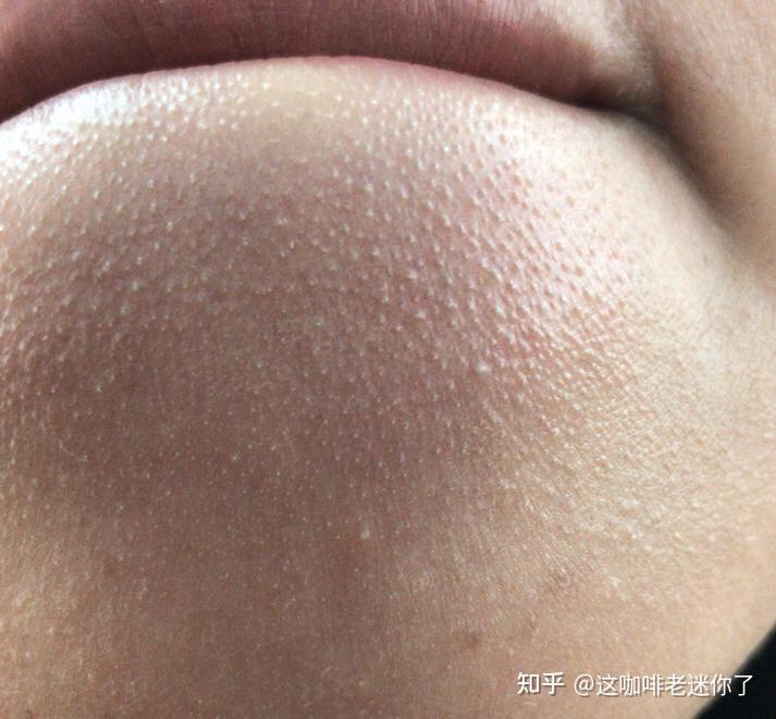 皮肤问题1:长闭口粉刺 敏感肌