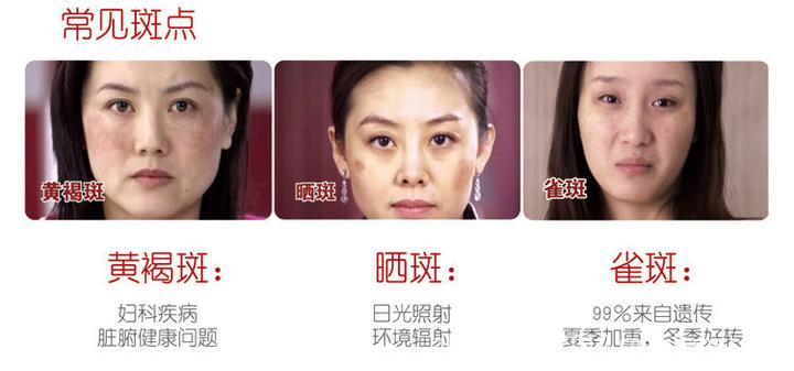 正确认识和治疗黄褐斑 知乎