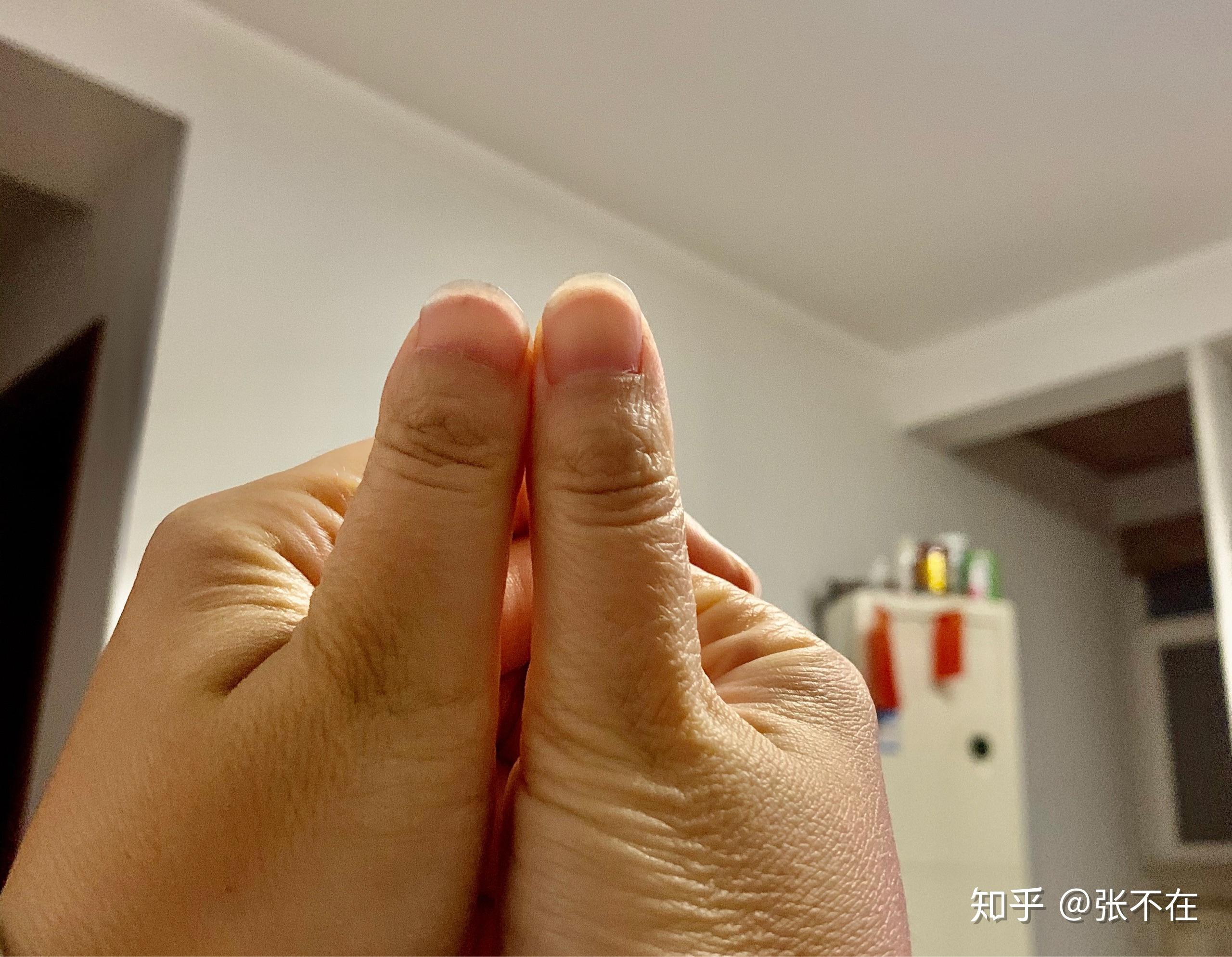 两个手的大拇指不对称?一个正常,一个短胖?这和什么有关?