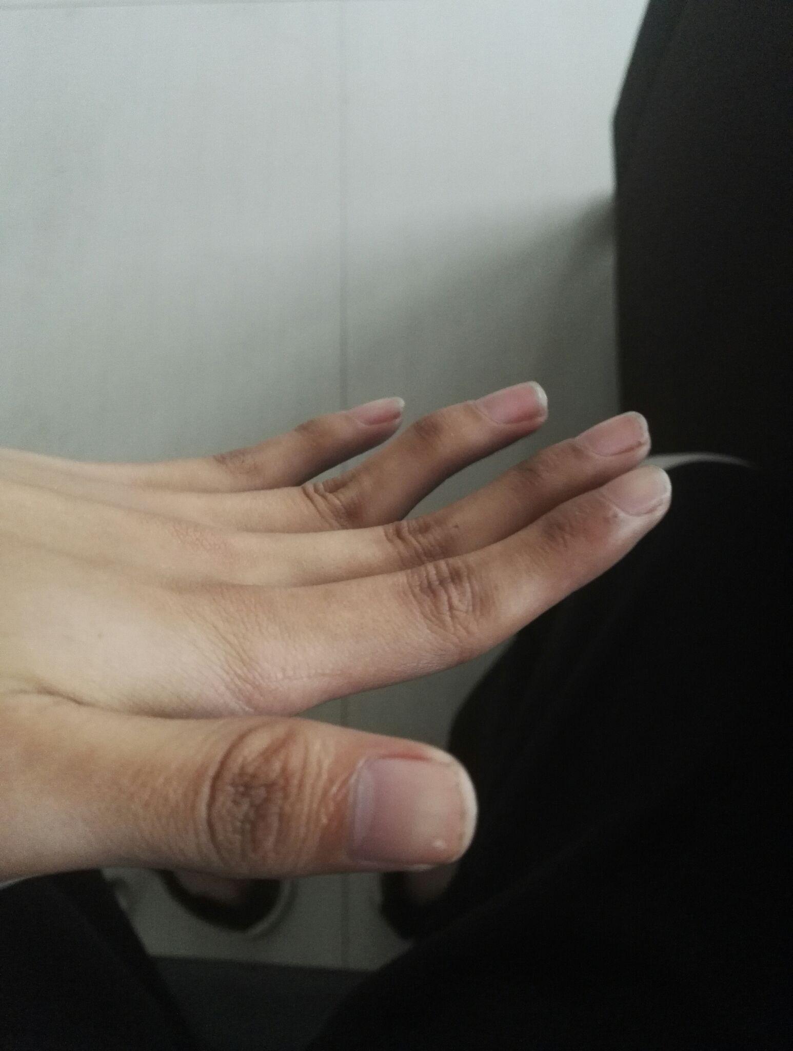 为什么我的手指伸不直