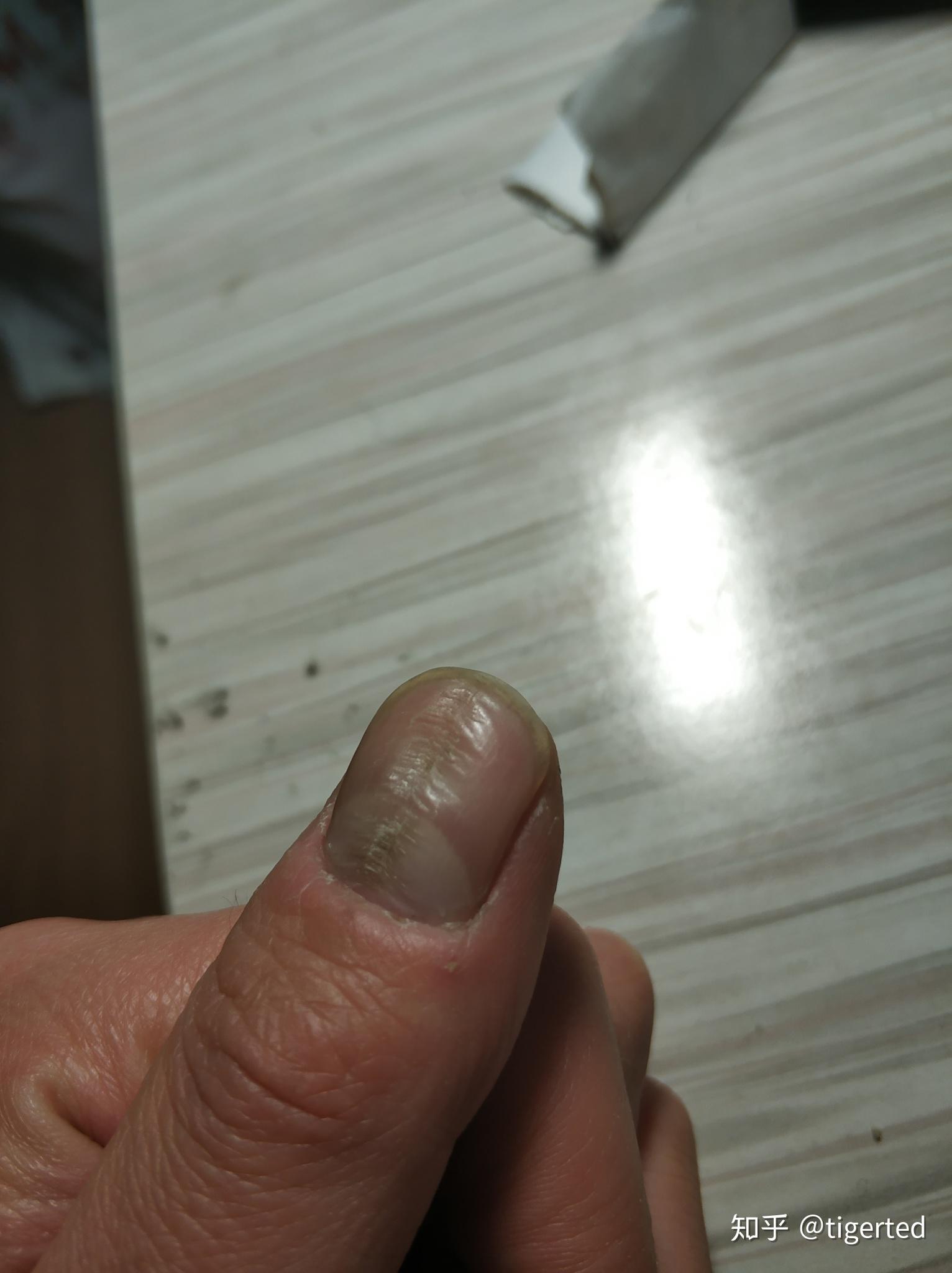 大拇指指甲凹陷一个坑图片