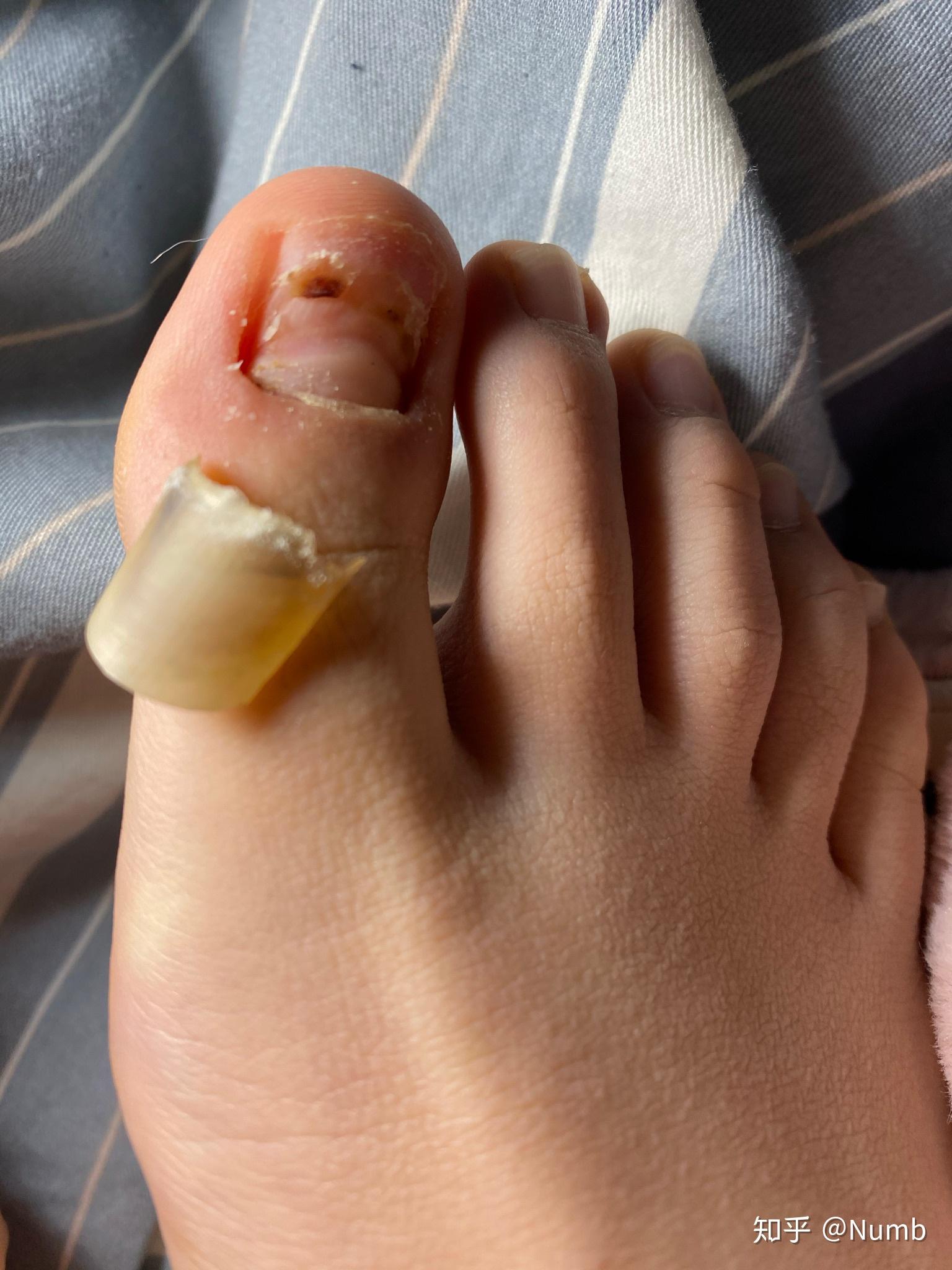 大脚趾甲盖整个掀起来了怎么办? - 知乎