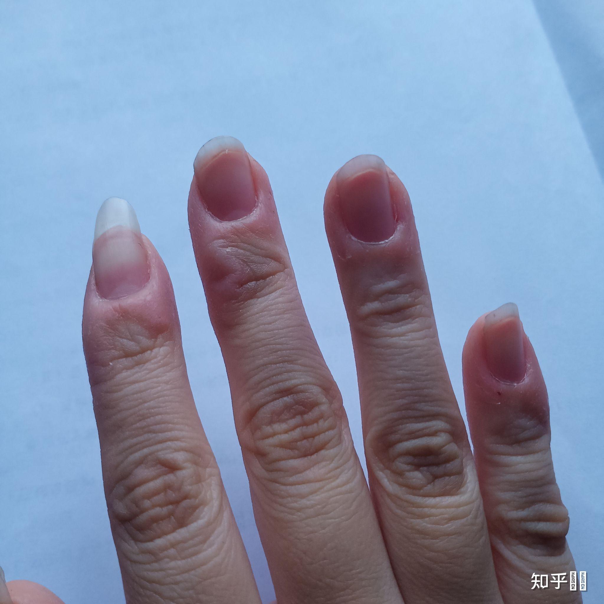 强迫性皮肤剥离症?