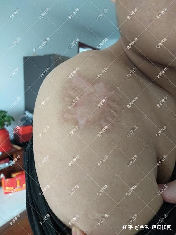 【真实案例】北京陈先生右肩膀疤痕疙瘩治疗案例