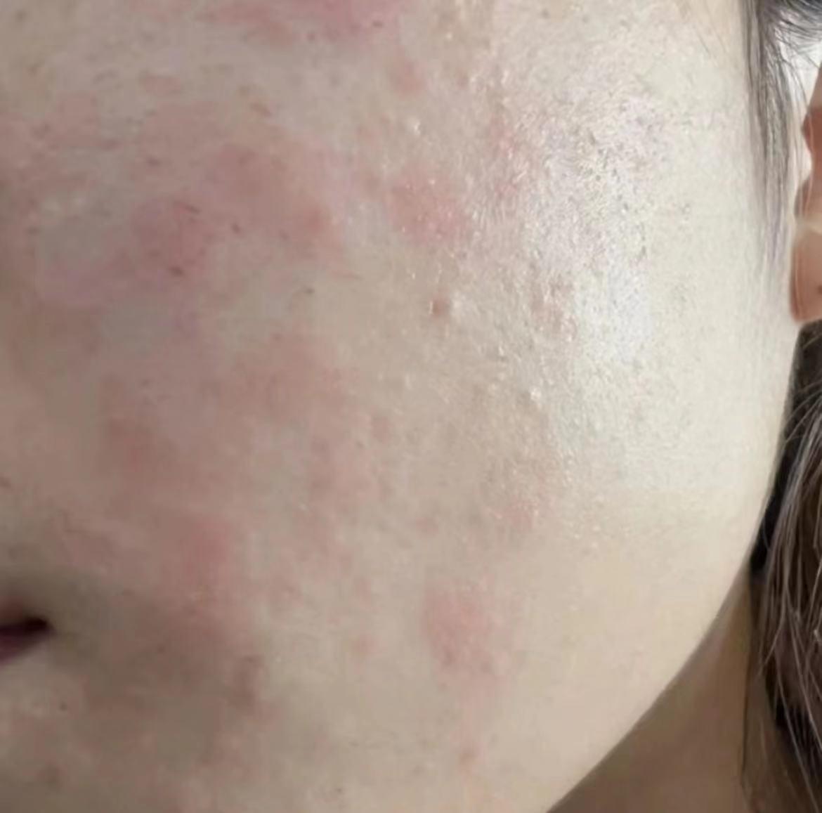 秋冬季脸上干痒起皮,干敏肌秋冬如何正确护肤?