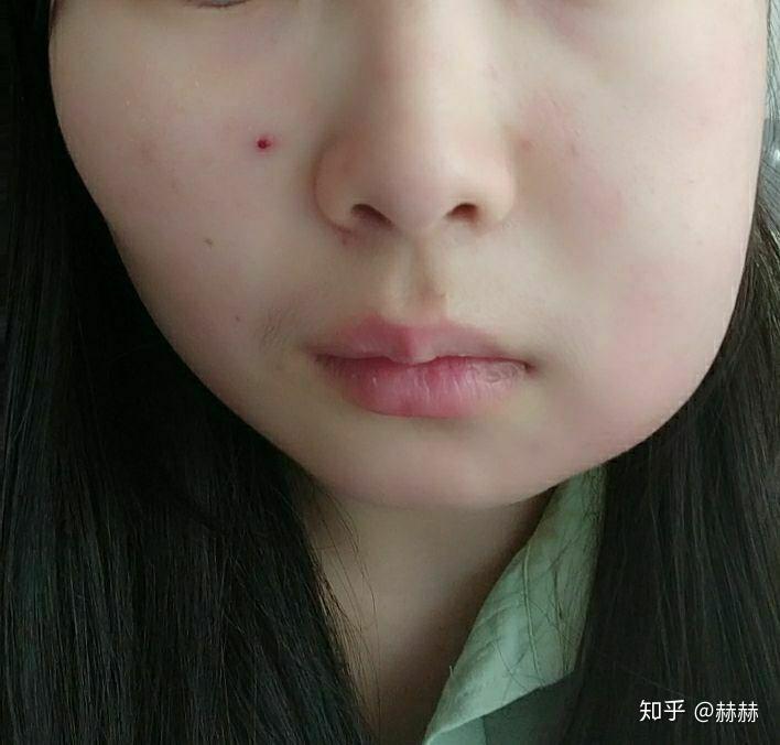 拔水平阻生智齿术后第二天脸肿了请问几天能消肿