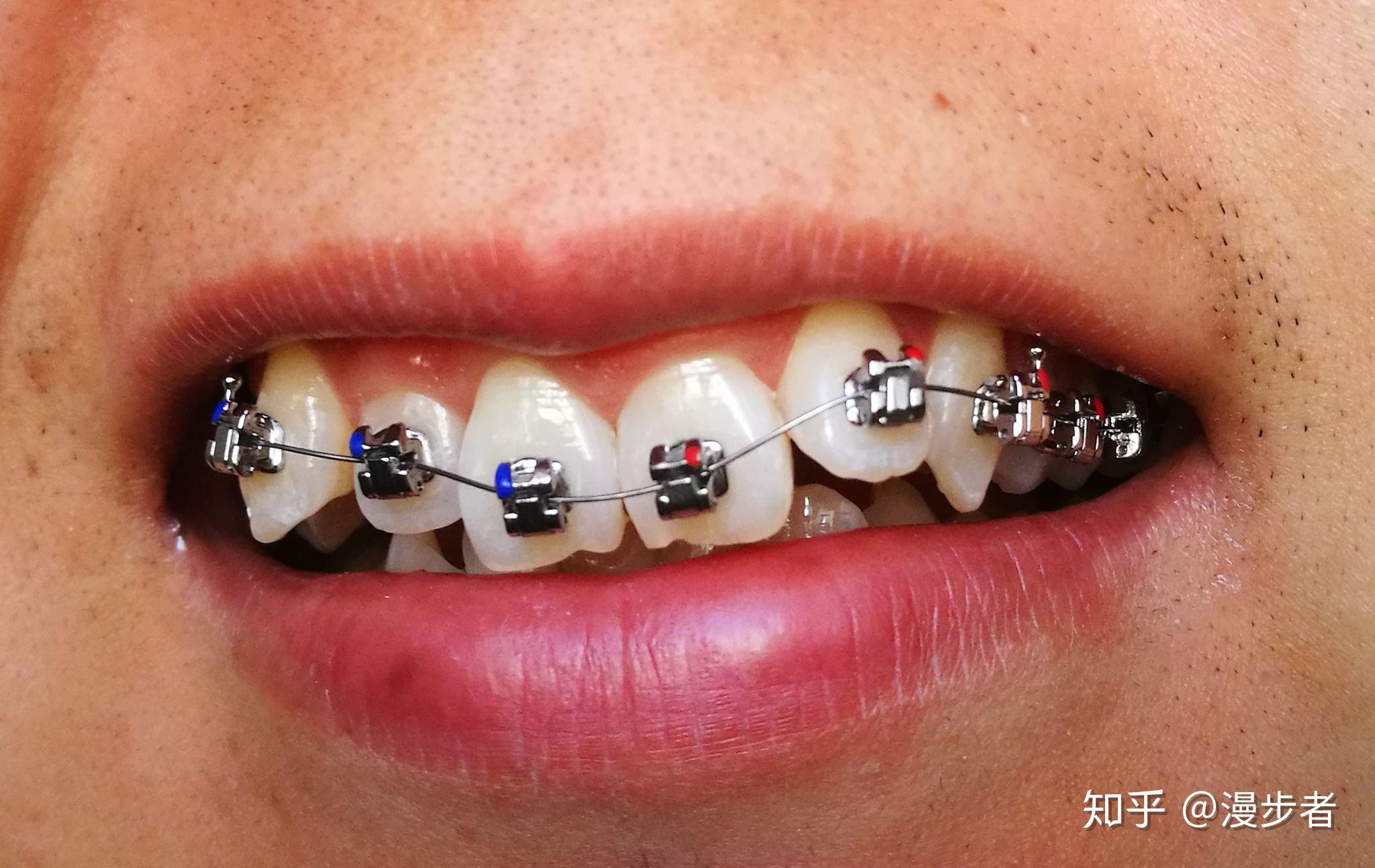 正畸用的进口的自锁托槽和国产的自锁托槽有什么区别?