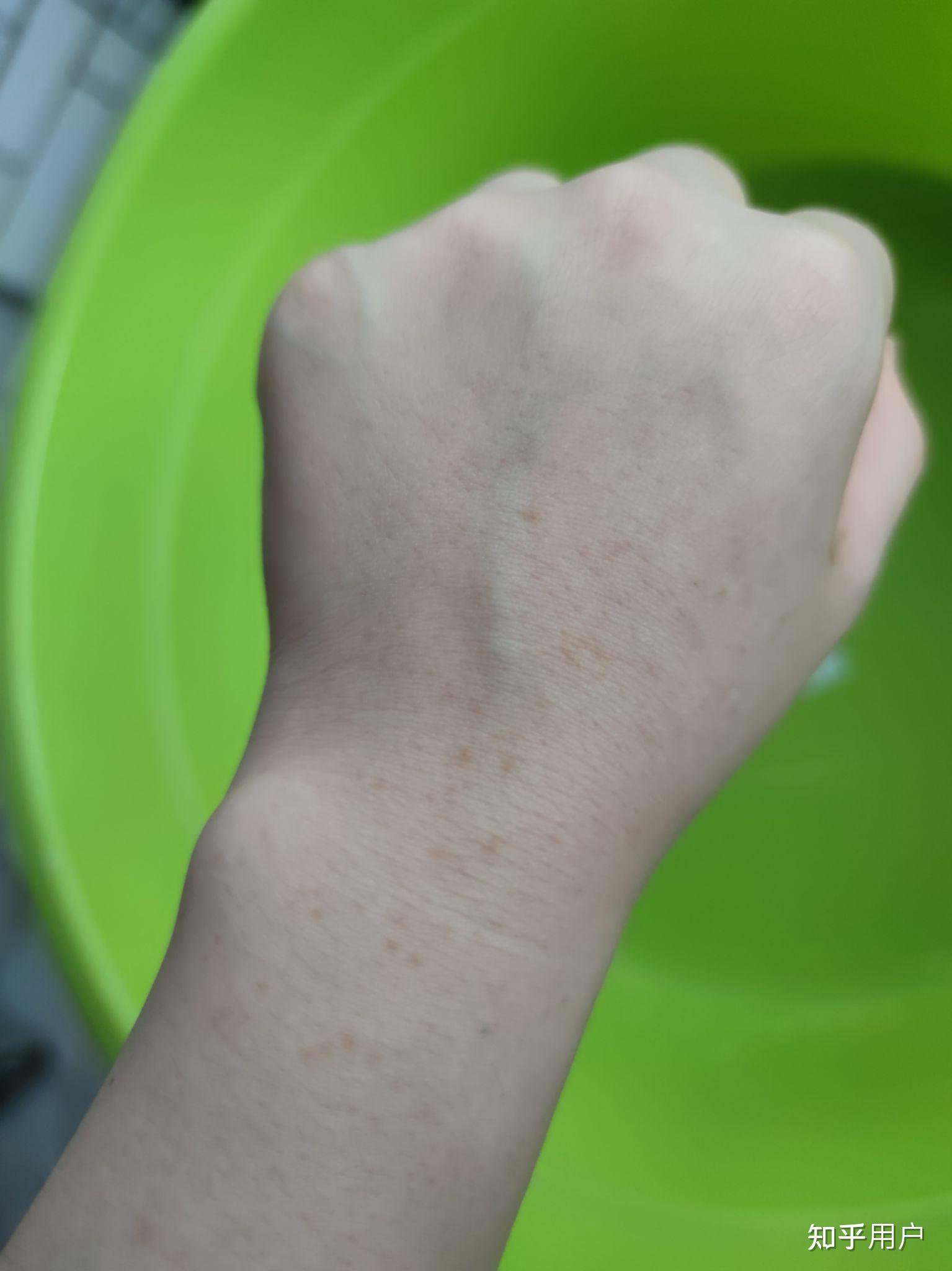 手上长了许多斑这是怎么回事呢