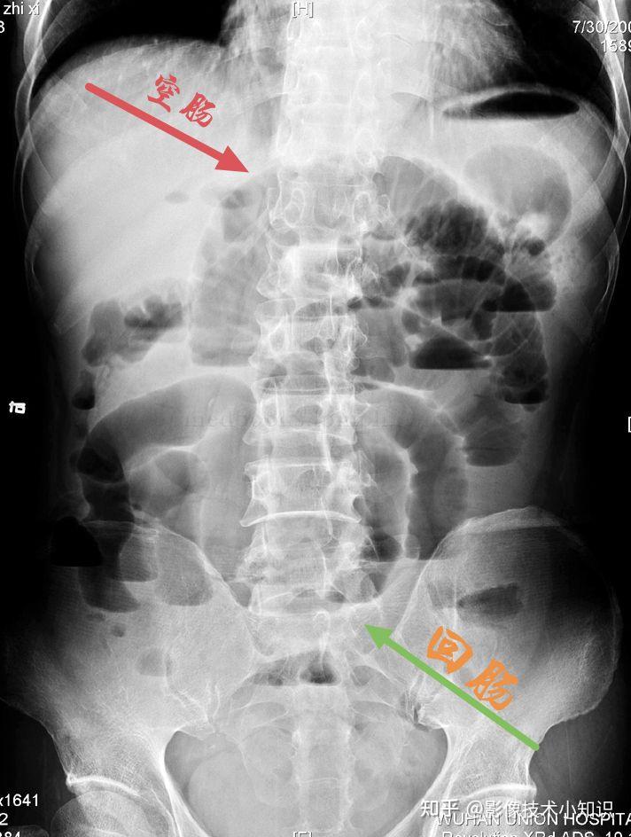 肠梗阻x线表现图片图片