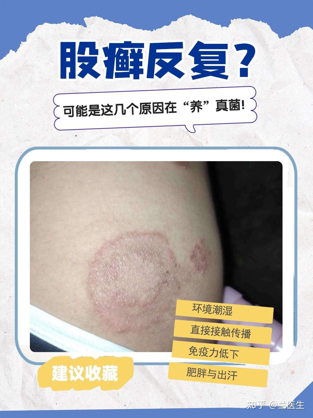 有哪种方法可以彻底根治股癣？ 知乎 