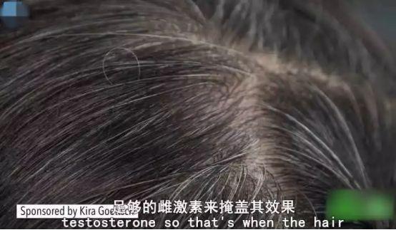 什么原因会引起脱发掉发 v2-fe3558794bfa2973d9f5ee41600537d3_1440w.jpg?source=172ae18b