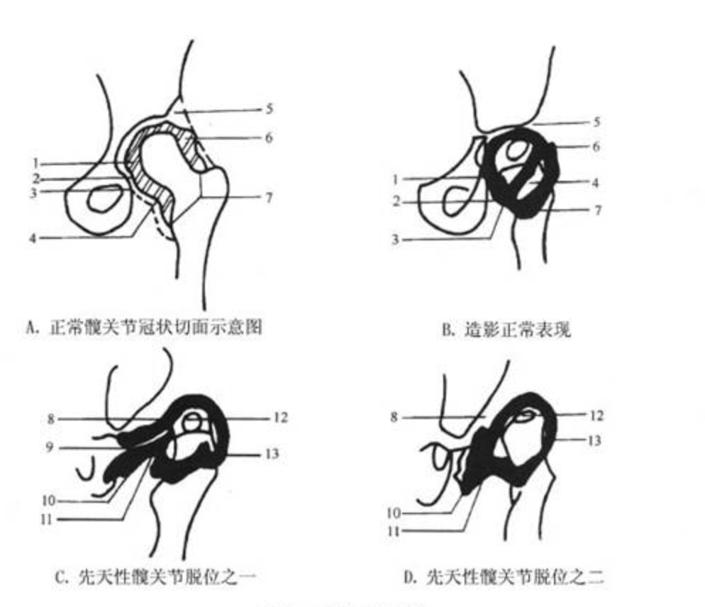 先天性髋关节脱位,成年后如何锻炼身体? - 知乎