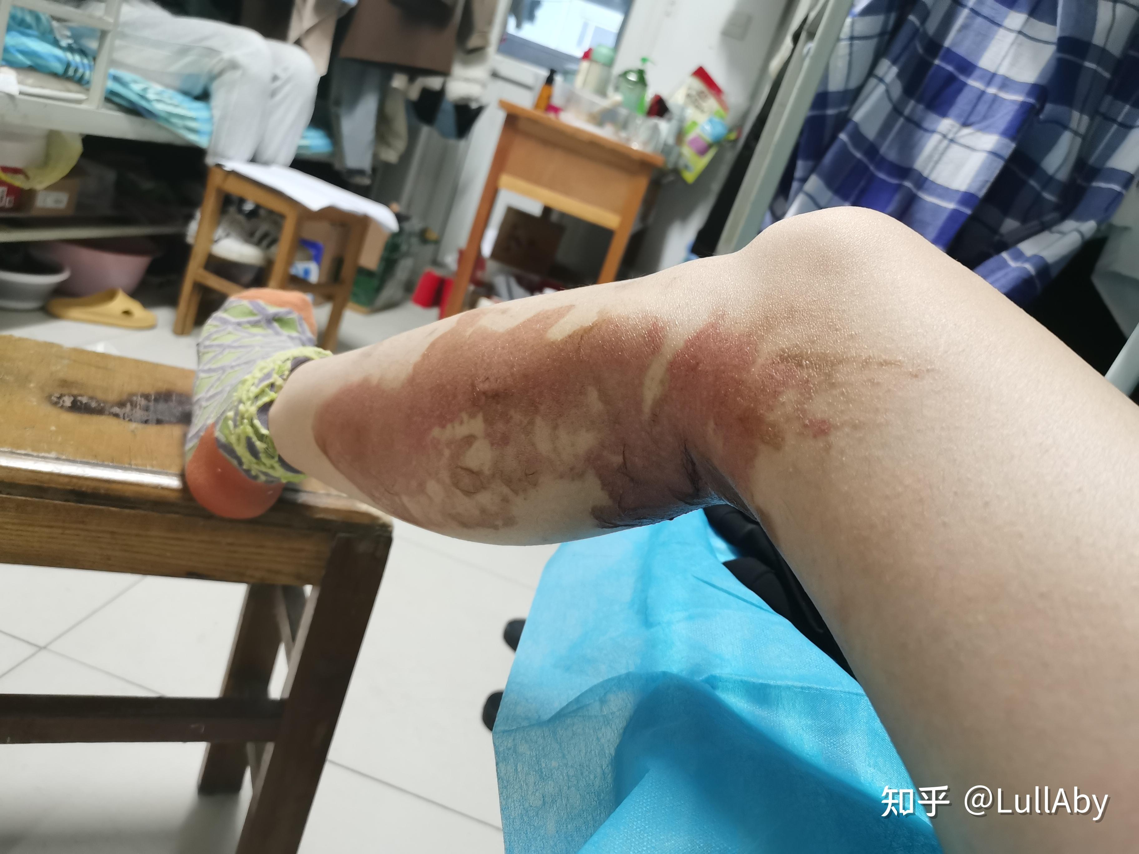 淺二度開水燙傷恢復過程