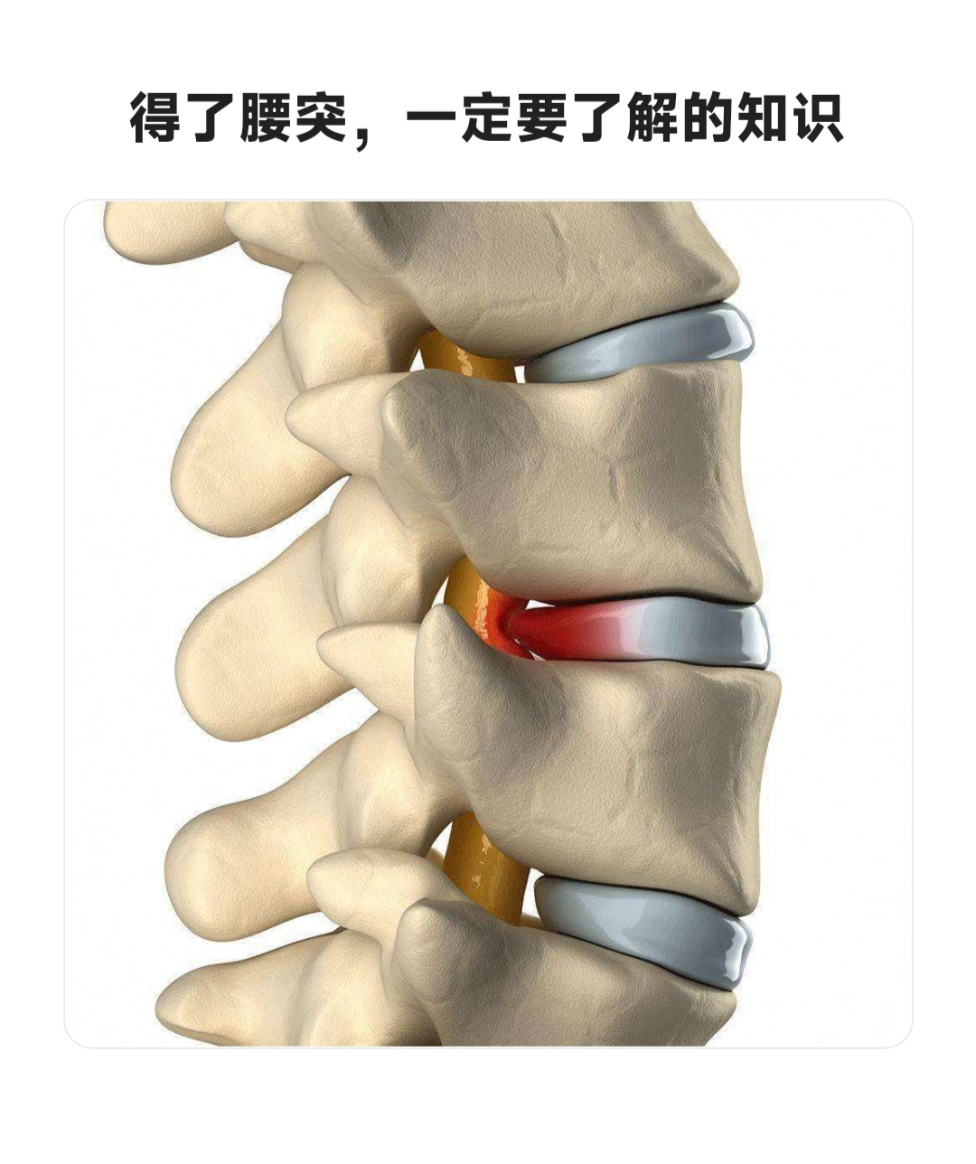 腰椎l4/5椎间盘位置图图片