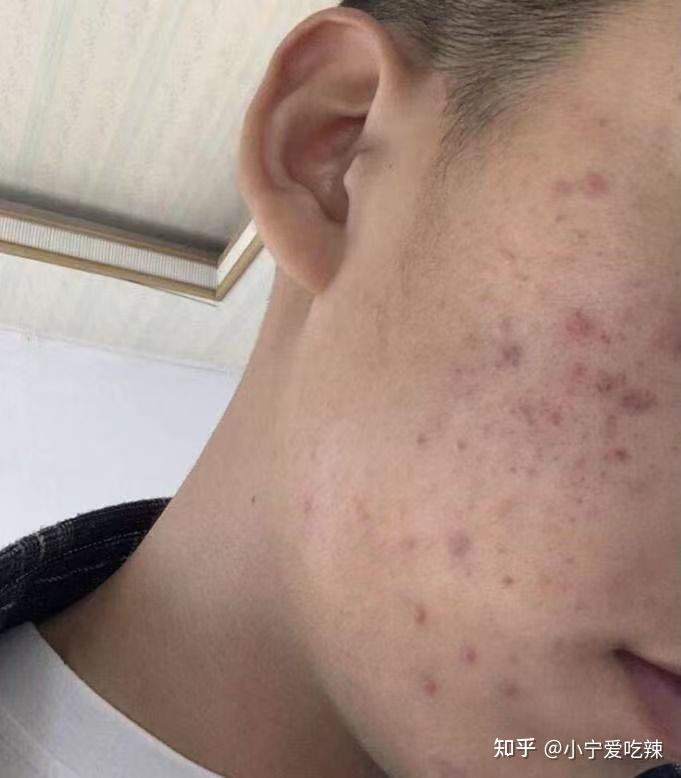 长痘的男生如何快速变帅气? - 知乎