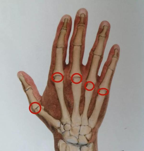 拇指腱鞘炎 学会这6招 轻松告别 妈妈手 知乎