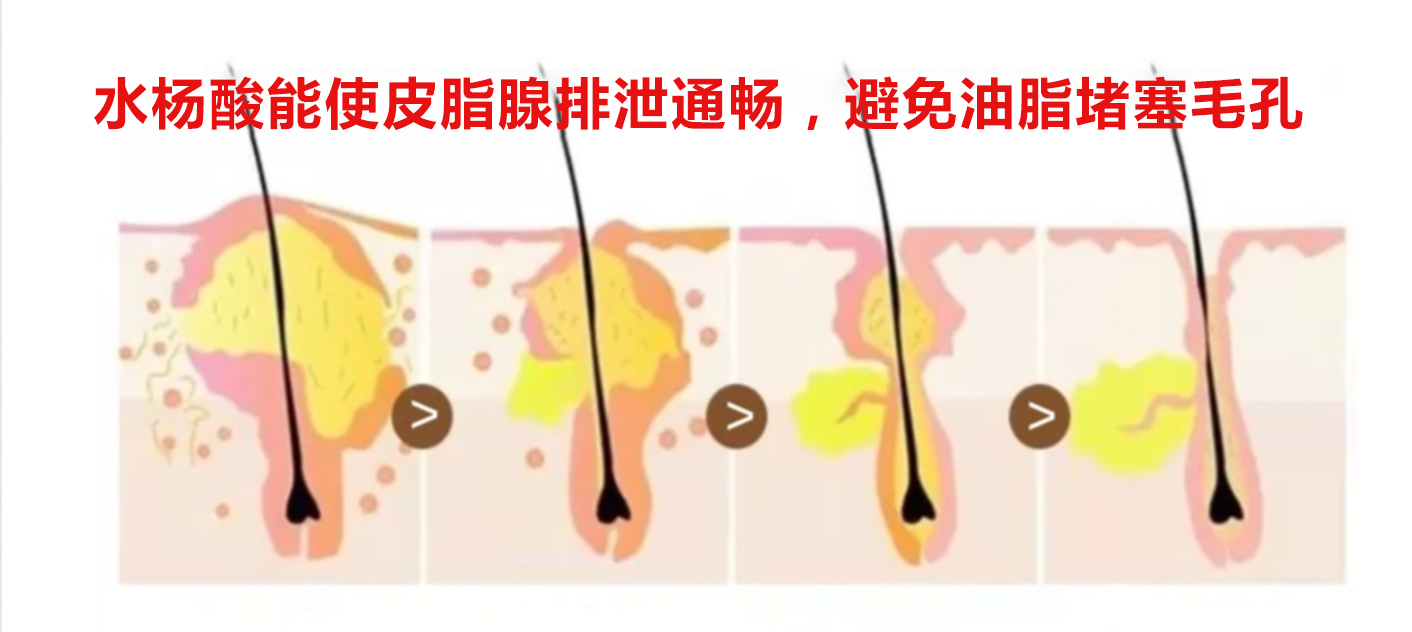男生怎样收缩毛孔?皮肤科【男士专用】收缩毛孔方案“出炉”,让你的毛孔直接缩小10倍! - 知乎
