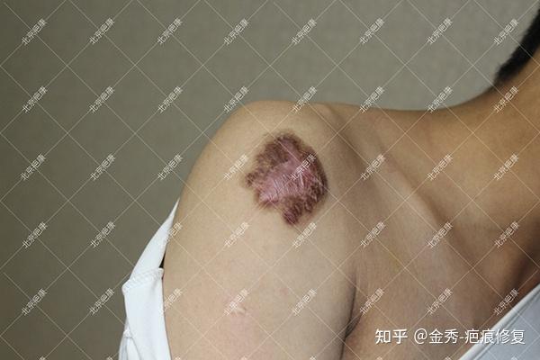【真实案例】北京陈先生右肩膀疤痕疙瘩治疗案例