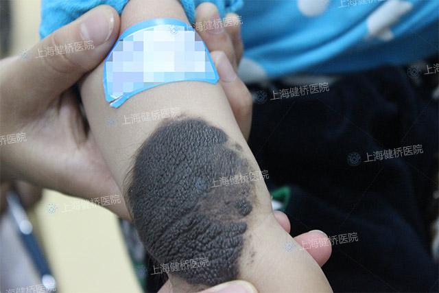 我的咖啡斑上长了毛这正常吗?