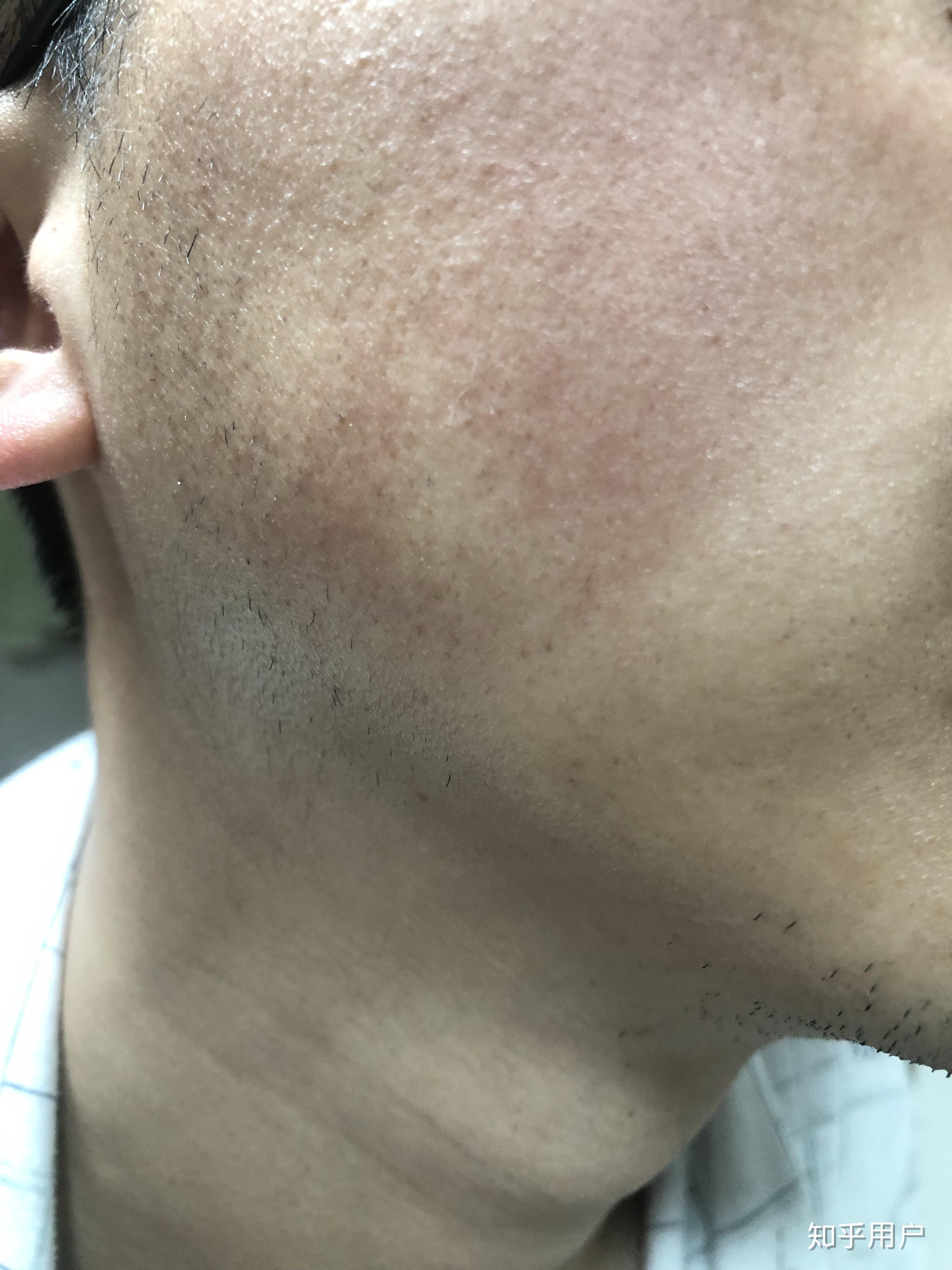 脸部毛周角化症怎么破? - 知乎