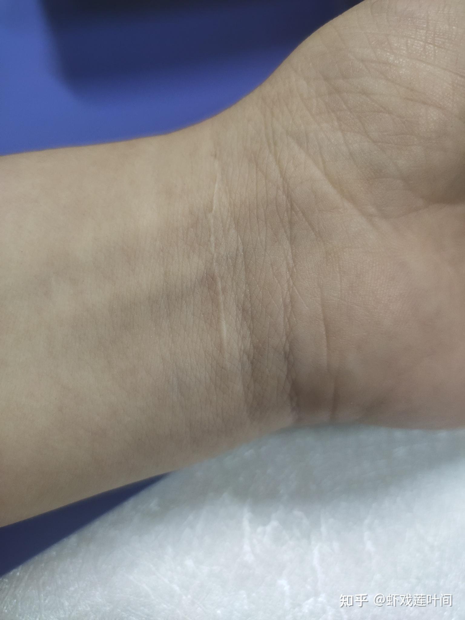 对于一个割腕过的人,未来如何向别人解释这道疤的由来? - 知乎