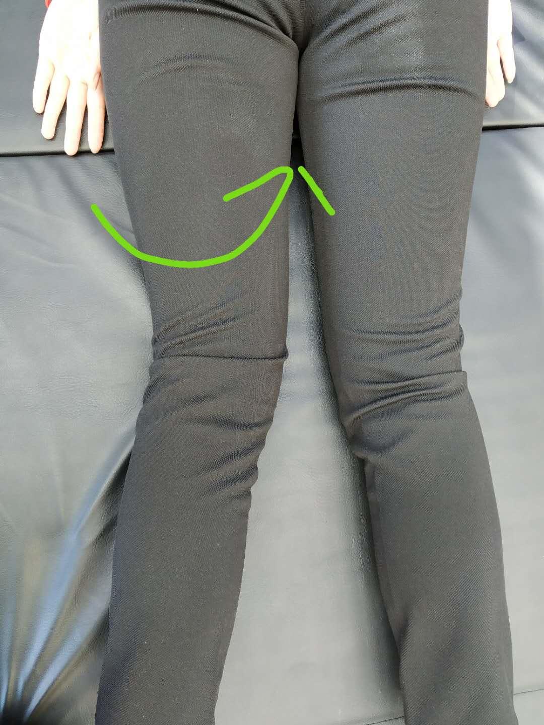 膝盖痛一定要做手术吗