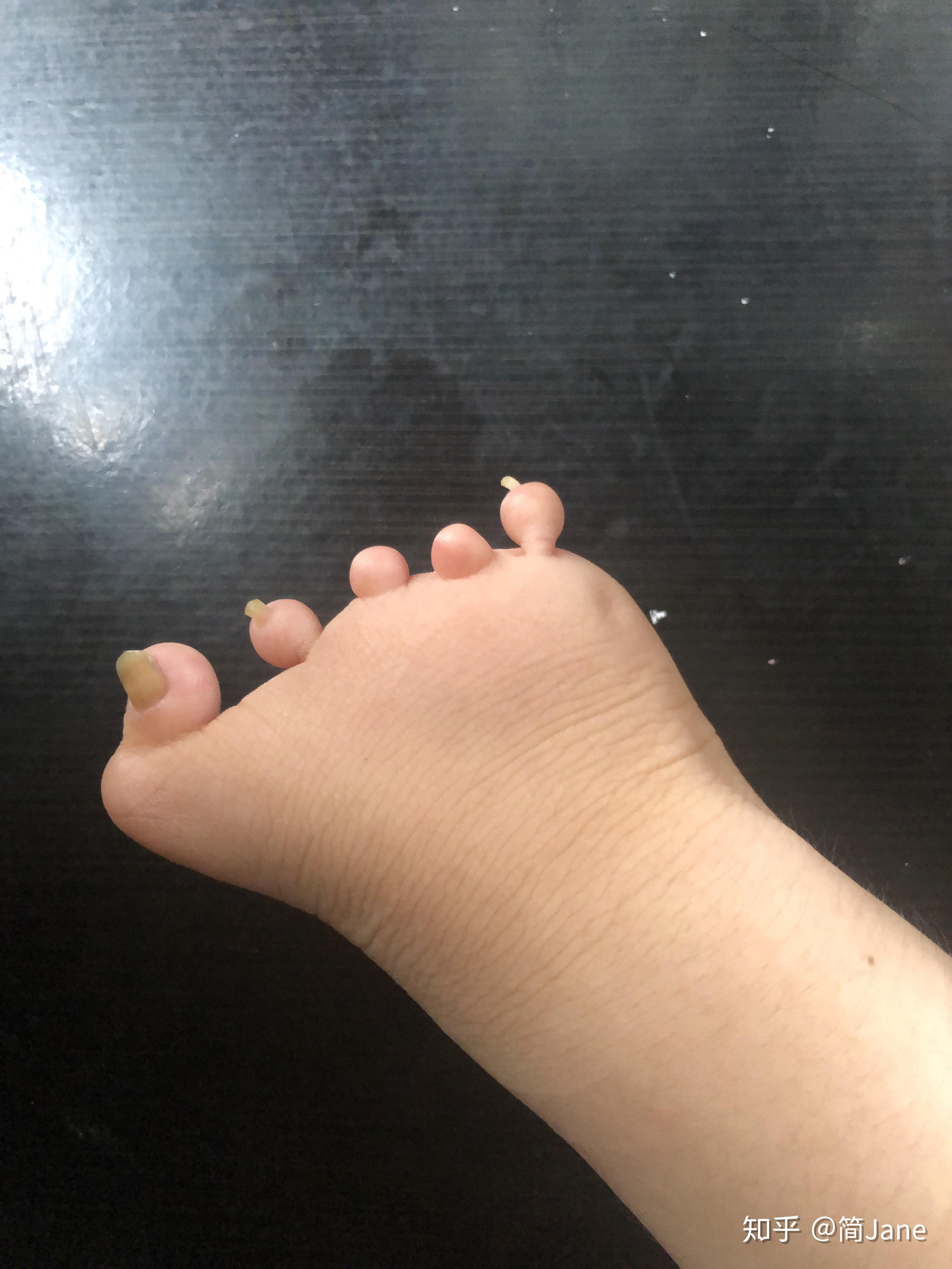 女生有波兰氏综合症是不是很悲哀? - 知乎