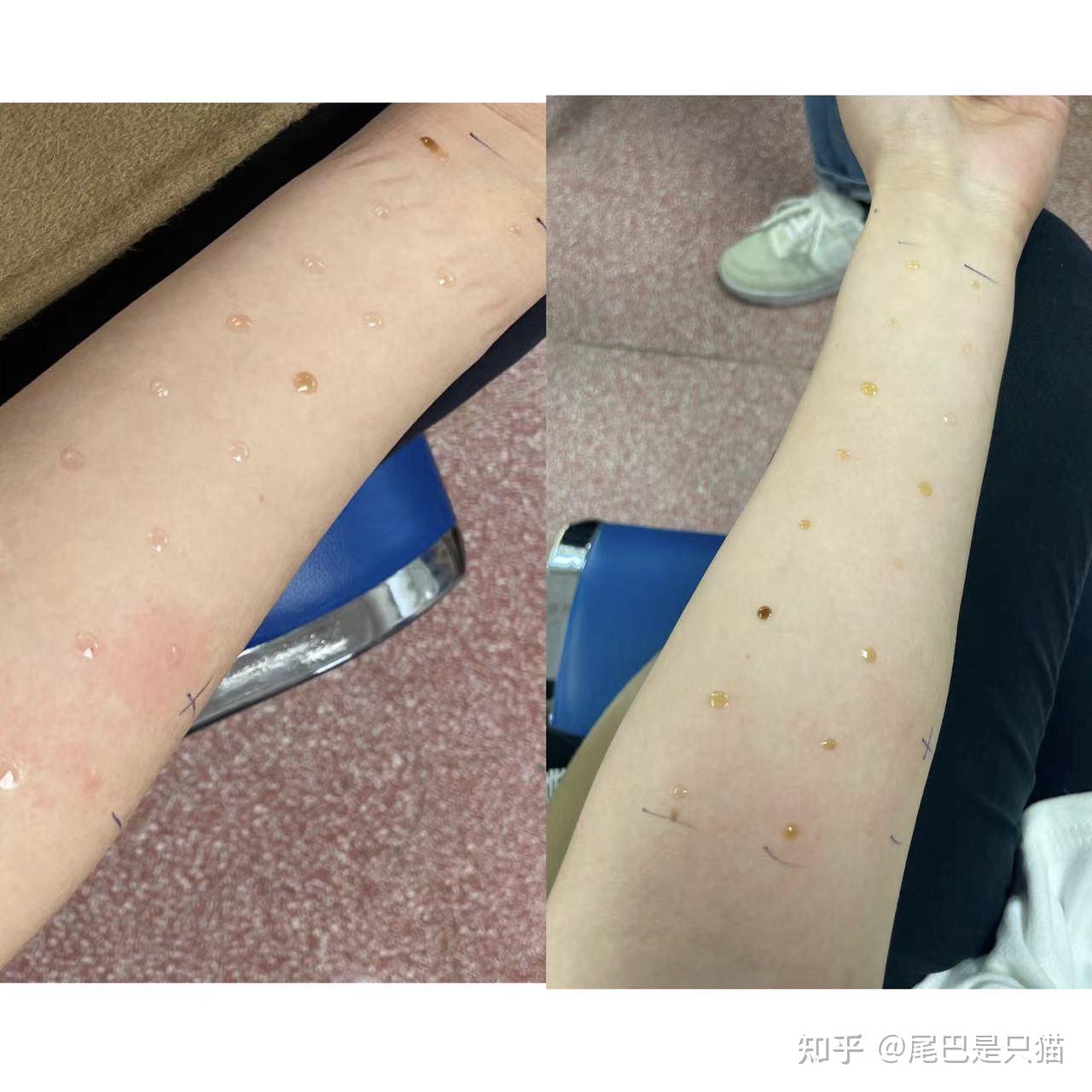 对猫皮屑过敏脱敏治疗真的有效果吗