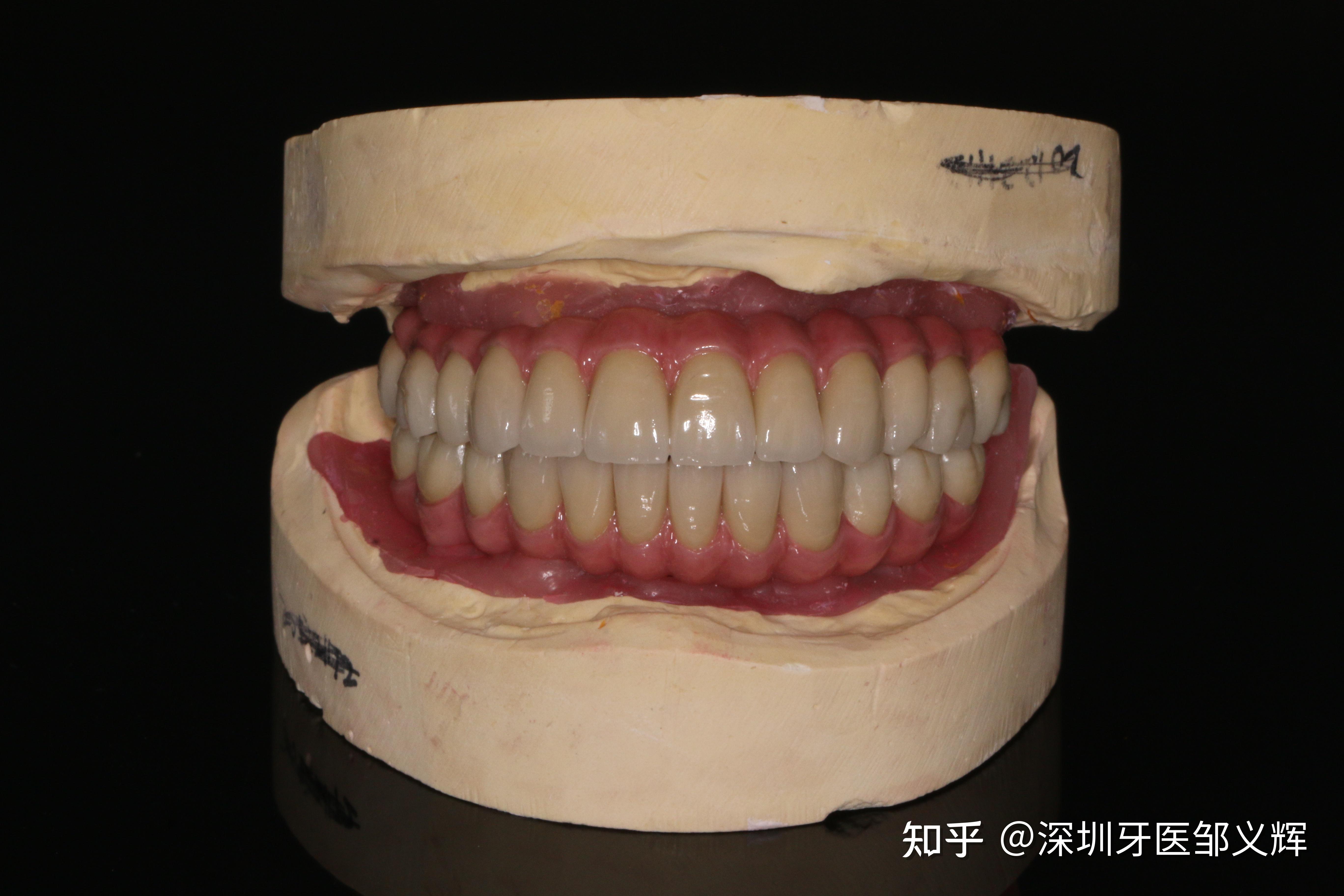 无牙颌修复一例