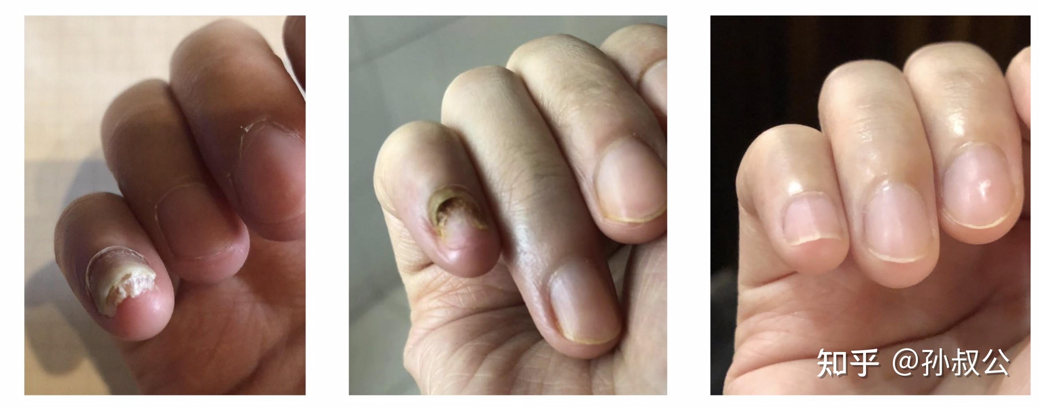有没有治疗好灰指甲的,分享一下过程吧?
