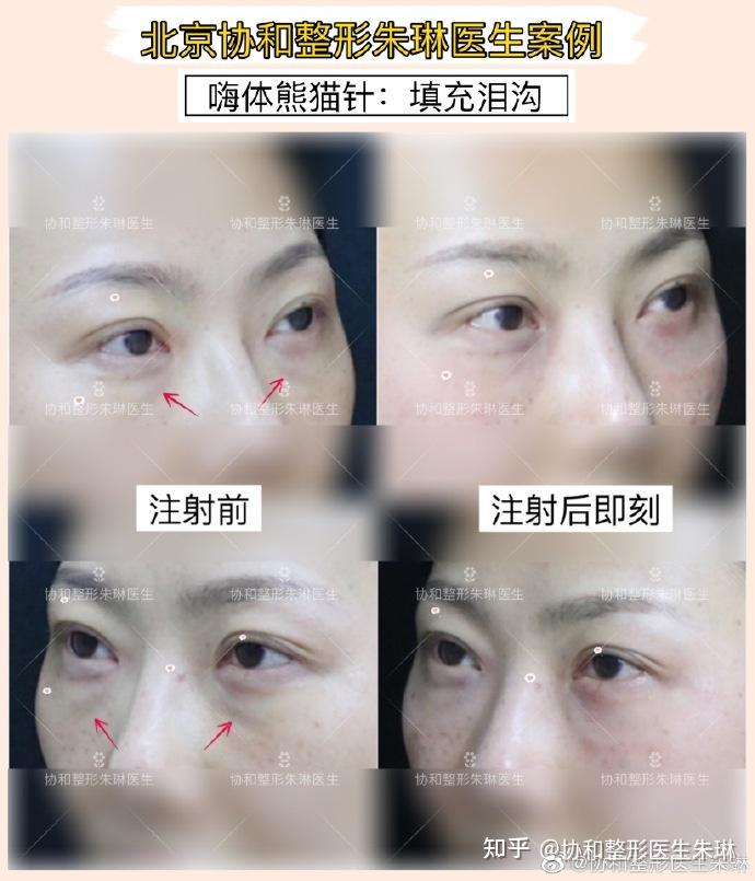 今日案例分享嗨体熊猫针填充泪沟