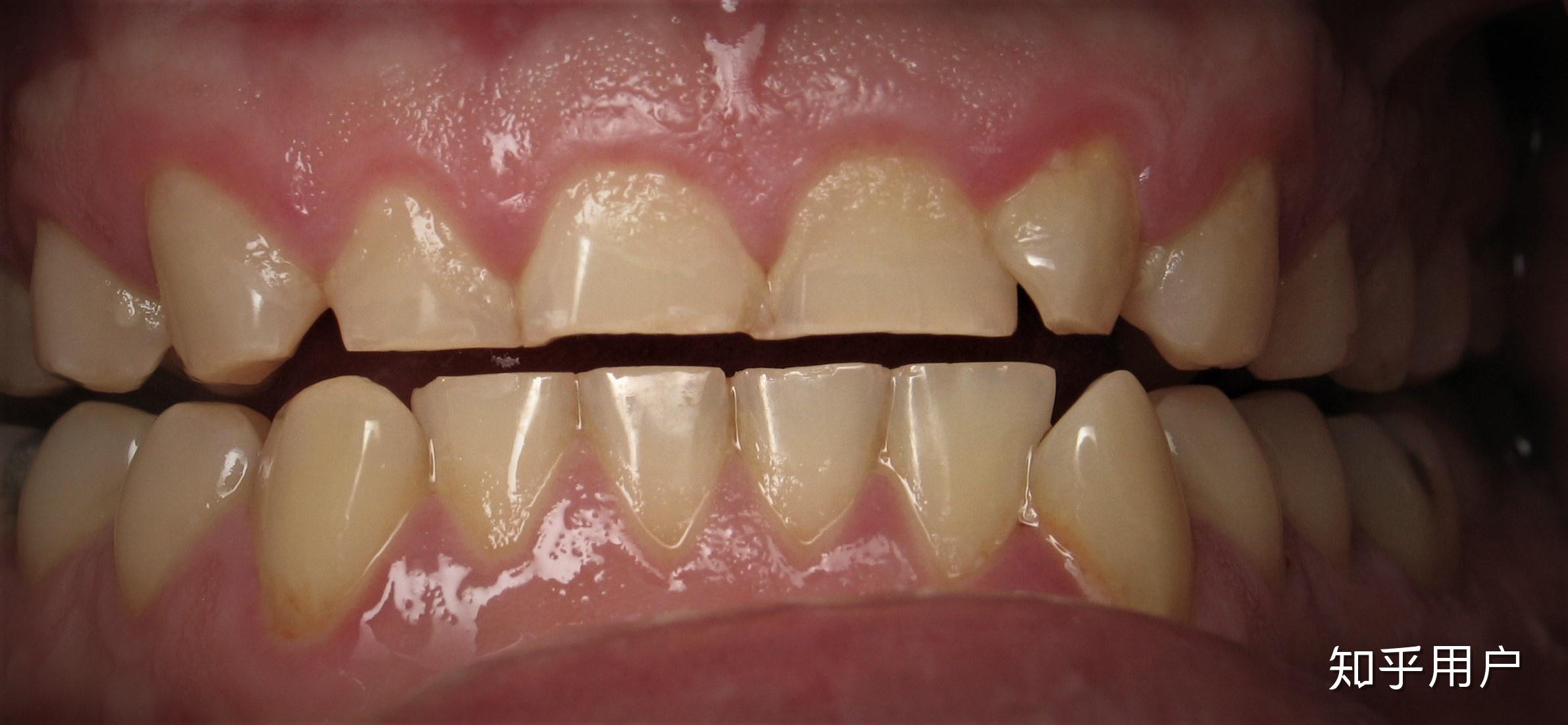 隐形矫治Ⅱ类减数第一前磨牙内收伴直立磨牙浅析-口腔科学-医学