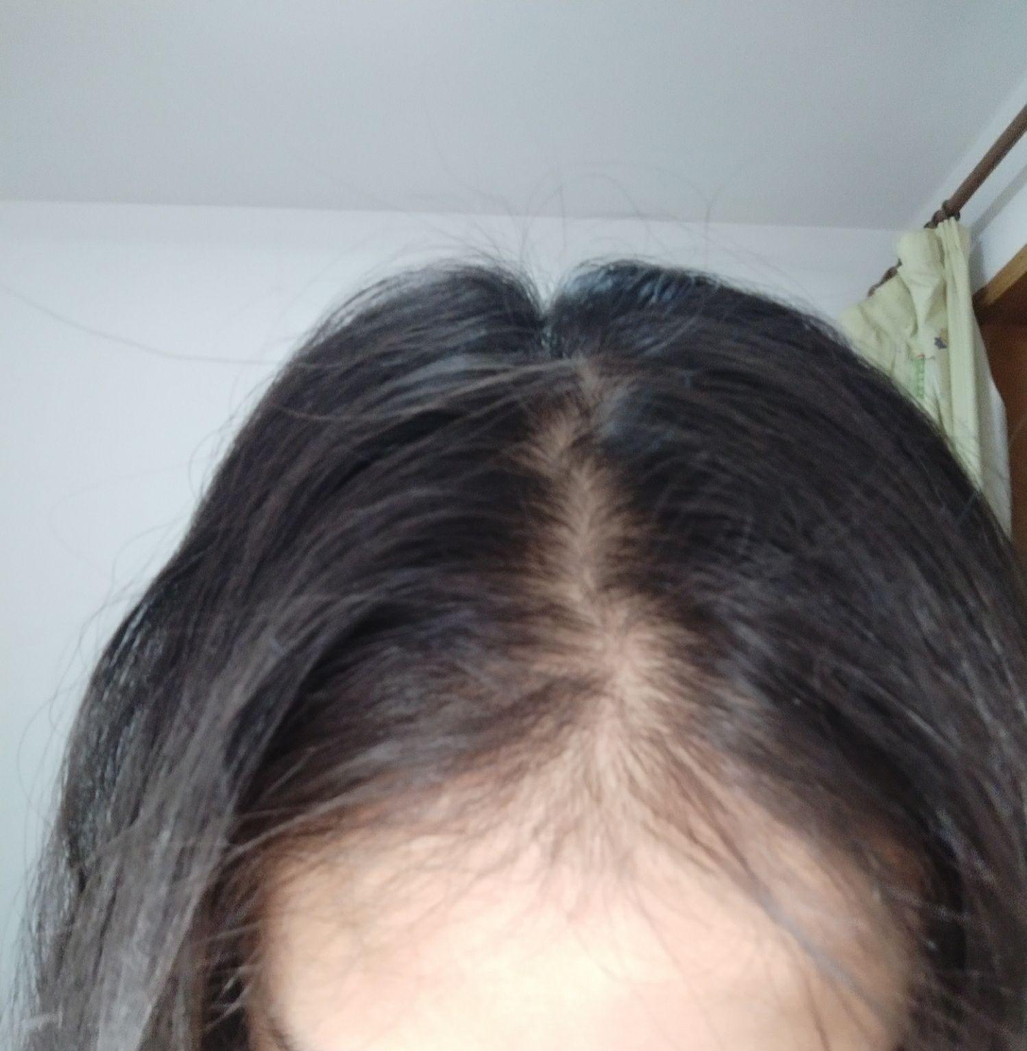 高三17岁发缝变成这样了,有没有跟我情况差不多的女生啊? - 知乎