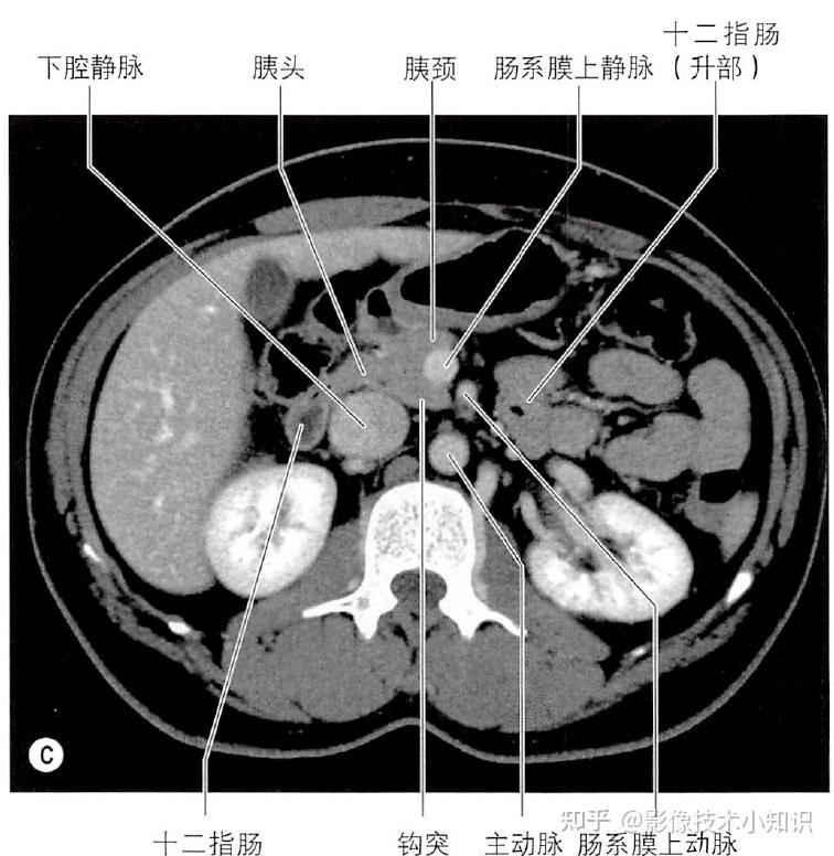胰腺影像解剖 - 知乎