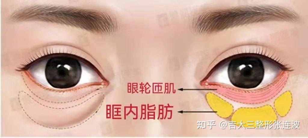 眼袋整形 - 知乎