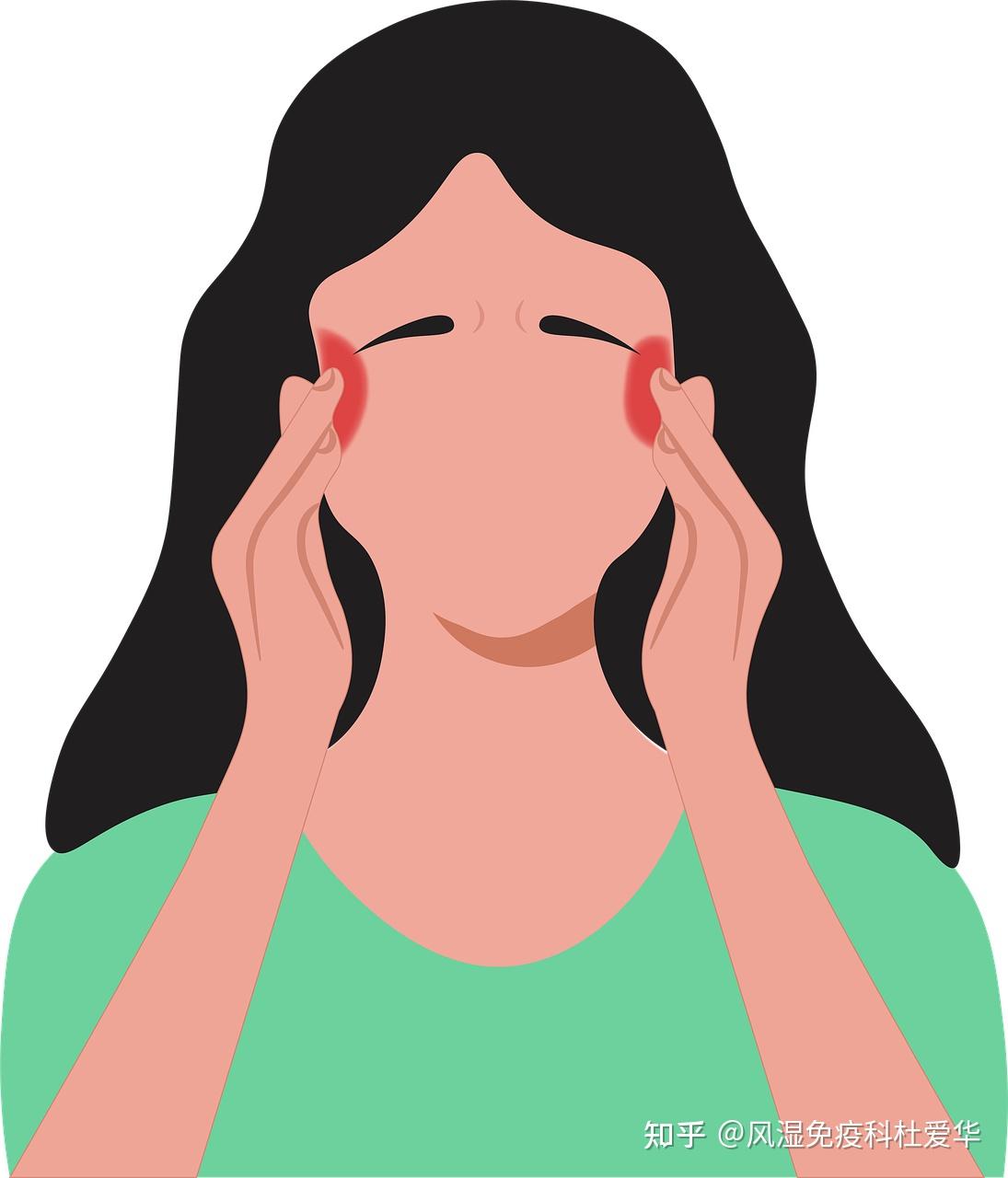 干燥综合症的症状：(干燥综合症的诊断标准)