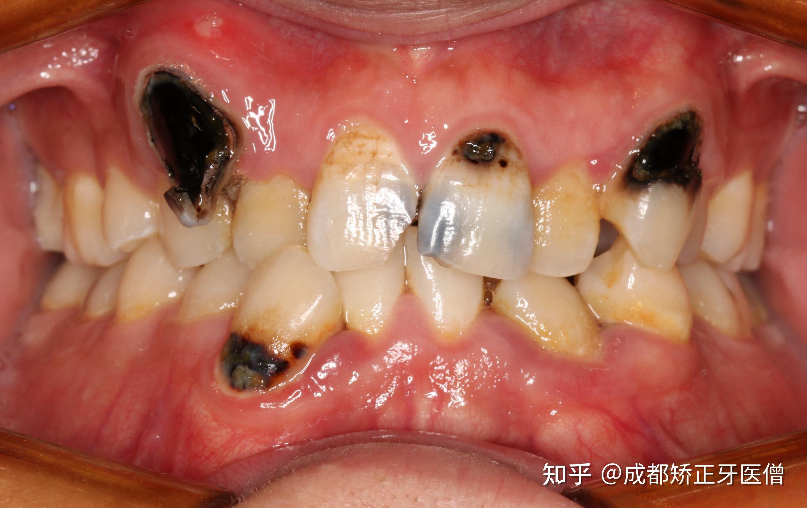 牙医碰见最烂的牙有多烂? 