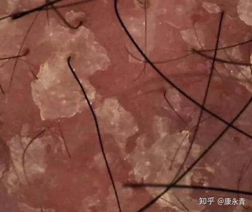 图片来源于网络所以对丙二醇过敏的人不能使用含有丙二醇的米诺地尔