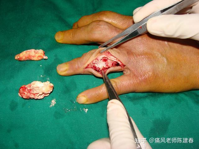 陈主任和你谈谈痛风石的诊断以及治疗方法