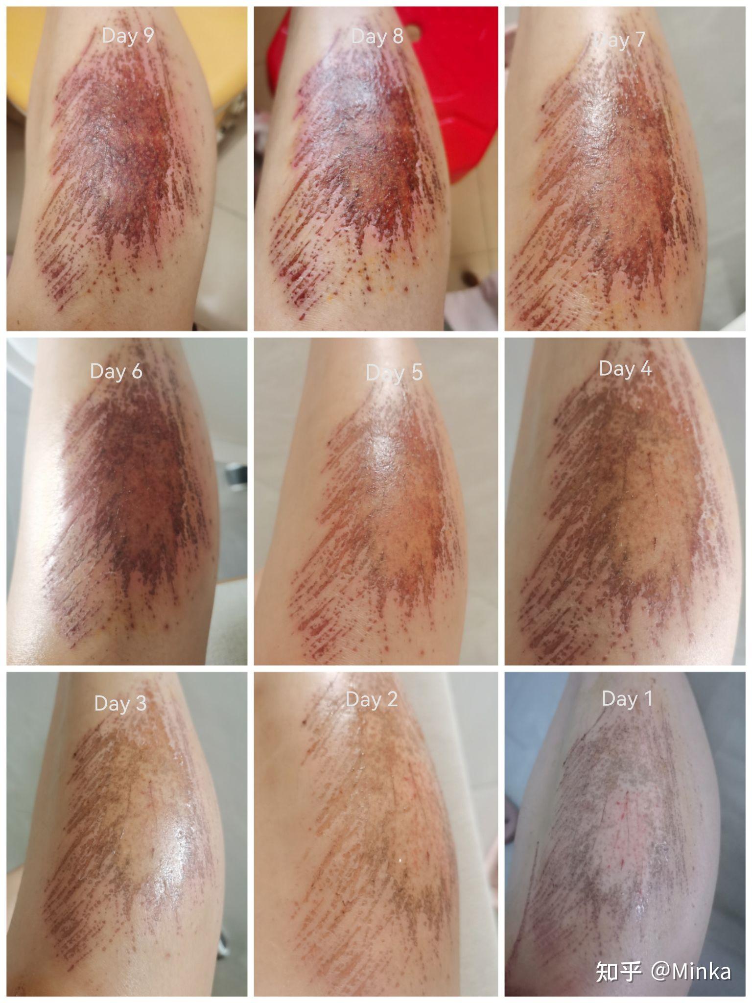 摔跤擦伤结痂愈合记录 - 知乎