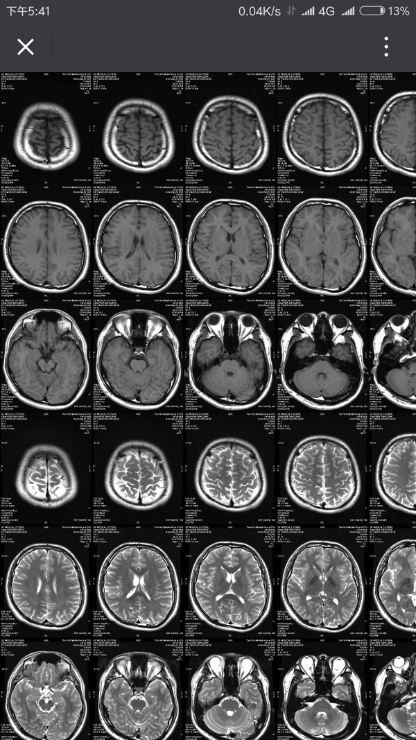 正常脑磁共振片子图片图片