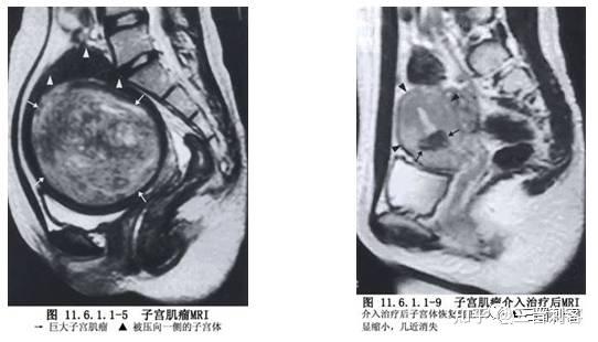 子宫肌瘤是癌症吗?要不要切子宫?可以介入微创治疗吗? - 知乎